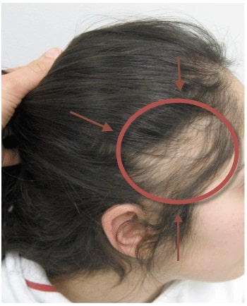 rụng tóc ở trẻ từ 3 đến 10 tuổi