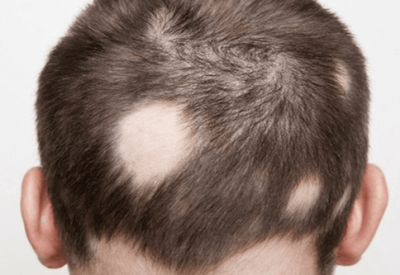 5+ Nguyên nhân gây rụng tóc ở trẻ từ 3 đến 10 tuổi