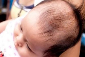 5+ Nguyên nhân khiến trẻ bị rụng tóc đỉnh đầu và cách khắc phục