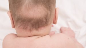 Read more about the article Rụng tóc ở trẻ em – Những lưu ý cho cha mẹ có con dưới 9 tháng tuổi bị rụng tóc
