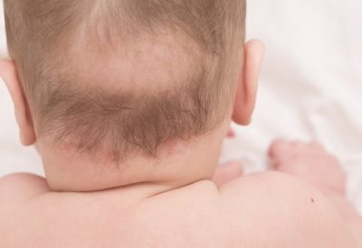 Rụng tóc ở trẻ em – Những lưu ý cho cha mẹ có con dưới 9 tháng tuổi bị rụng tóc