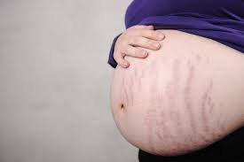 Sắc tố da thường đậm hơn ở vùng bụng, núm vú, các vết rạn bụng, mặt do sự thay đổi hóc môn khi mang thai. 