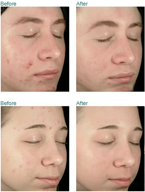 hình ảnh trước và sau khi sử dụng Obagi Clenziderm M.D Pore Therapy