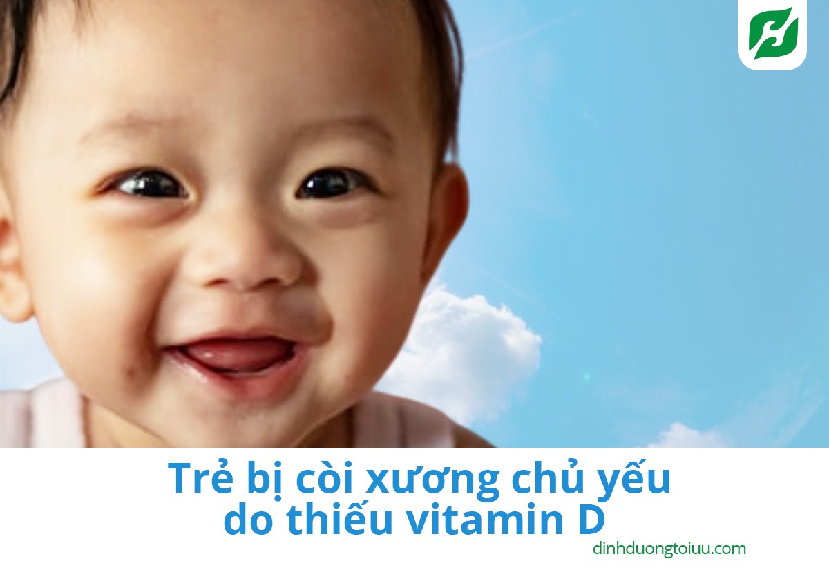 Trẻ bị còi xương chủ yếu do thiếu vitamin D