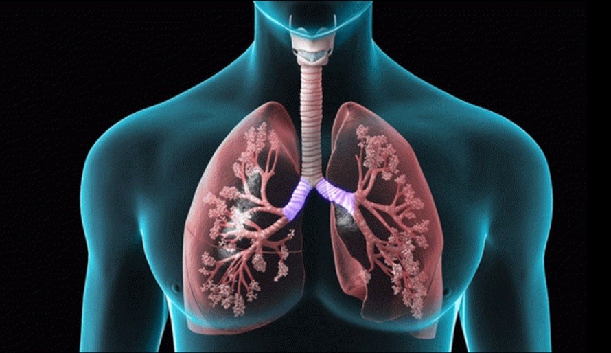 tổn thương phổi sau covid 1