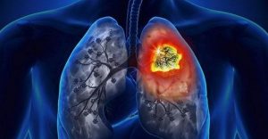 Read more about the article 5 triệu chứng ung thư phổi giai đoạn cuối người bệnh cần quan tâm