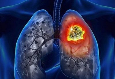 5 triệu chứng ung thư phổi giai đoạn cuối người bệnh cần quan tâm