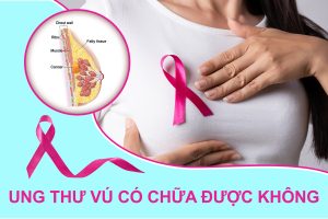 Read more about the article Giải đáp thắc mắc: Ung thư vú có chữa được không?
