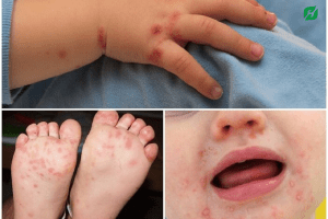 Dấu hiệu bệnh tay chân miệng ở trẻ em