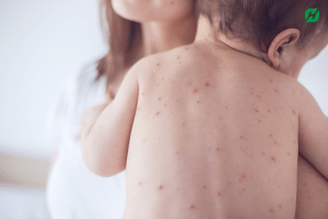Dấu hiệu của bệnh sốt xuất huyết ở trẻ em 