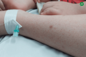 Dấu hiệu của bệnh sốt xuất huyết ở trẻ em 