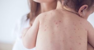 Read more about the article Cảnh báo về dấu hiệu của bệnh sốt xuất huyết ở trẻ em