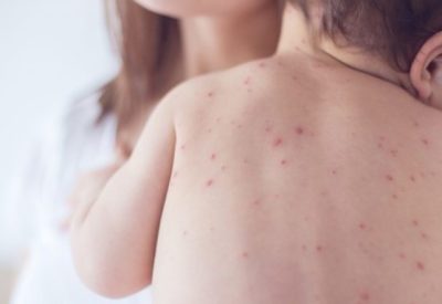 Cảnh báo về dấu hiệu của bệnh sốt xuất huyết ở trẻ em