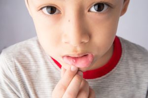 Read more about the article Trẻ bị nhiệt miệng nên ăn gì? Bật mí cách chữa nhiệt miệng hiệu quả ở trẻ