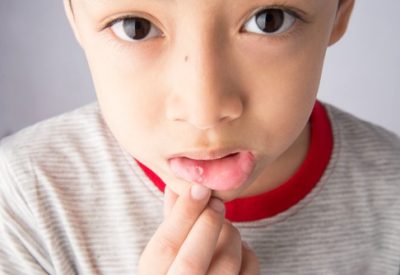 Trẻ bị nhiệt miệng nên ăn gì? Bật mí cách chữa nhiệt miệng hiệu quả ở trẻ