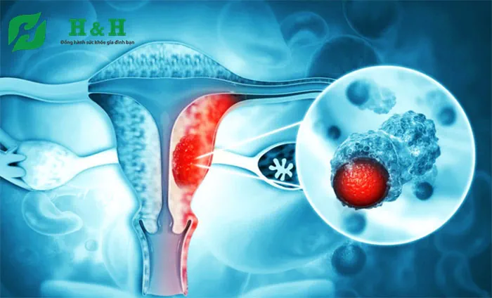 Các bệnh ung thư thường gặp ở phụ nữ